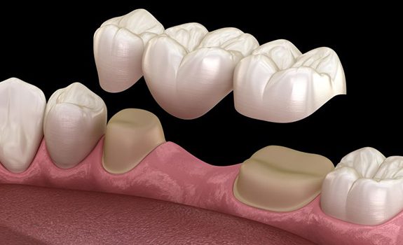 Illustration of a traditional dental bridge being placed on teeth