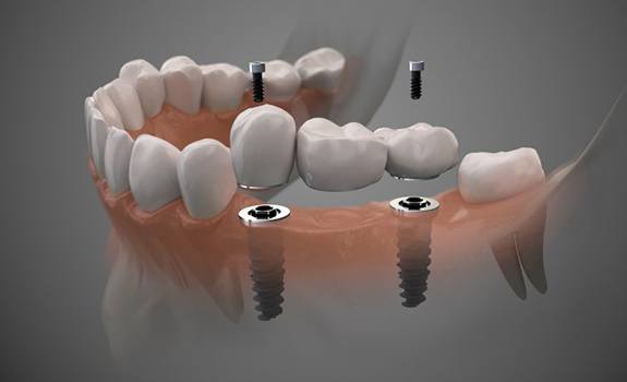 Illustration showing dental implant bridge