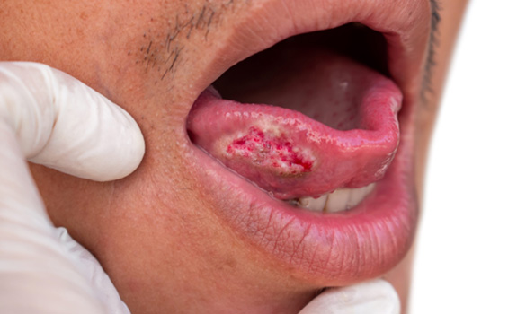 Person with oral sores on tongue