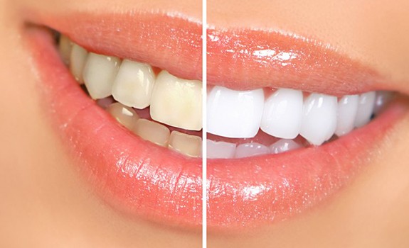Before and after teeth whitening